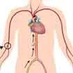 Coronary Angioplasty In India, Coronary Angioplasty Procedure In India, Coronary Angioplasty Cost In India Coronary Angioplasty In India, Coronary Angioplasty Procedure In India, Coronary Angioplasty Cost In India
