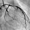 Coronary Angiography In India, Coronary Angiography Procedure In India, Coronary Angiography Cost In India Coronary Angiography In India, Coronary Angiography Procedure In India, Coronary Angiography Cost In India