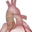 Bentall Surgery In India, Bentall Surgery Cost In India Bentall Surgery In India, Bentall Surgery Cost In India