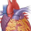 Heart Transplant Surgery In India Heart Transplant Surgery In India